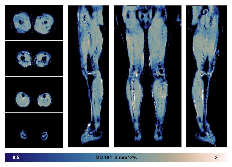 IVIM corrected whole leg muscle mean diffusivity obtained from diffusion tensor imaging.